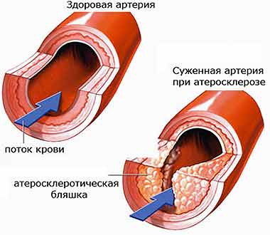 Атеросклероз - лікування народними засобами