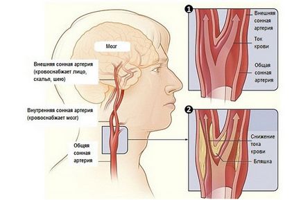 Carotis atherosclerosis tünetek, diagnózis és kezelés