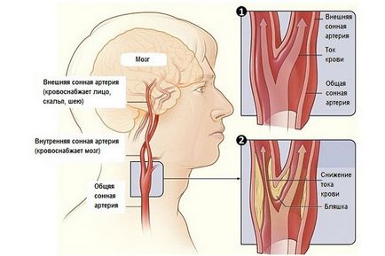 Атеросклероз сонних артерій симптоми, діагностика та лікування