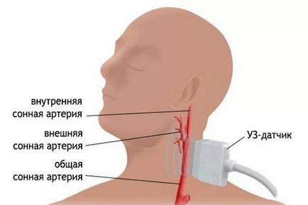 Ateroscleroza simptomelor arterelor carotide, diagnosticul și tratamentul