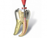 Tratamentul dentar fara durere in g