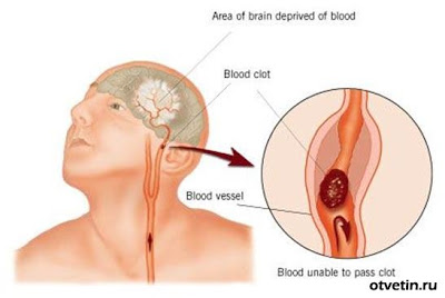 Blog tippek stroke mindenkinek tudnia kell!