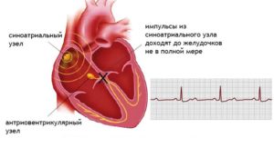 Blocarea simptomelor cardiace, metodele de tratament și detectarea bolilor