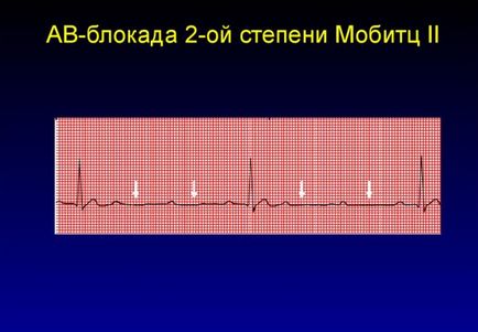 Блокада серця - види, причини, симптоми, діагностика, лікування та наслідки