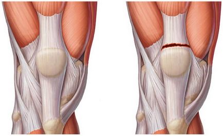 Durerea sub genunchi la spate cu flexiune și extensie, cauze și autodiagnosticare