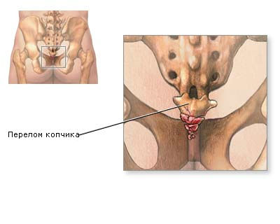 Durerea după o traumă a coastei - centrul de wellness al nitusului din Rostov