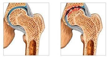 Dureri de spate și traumatism coccidial - centru - osteopat