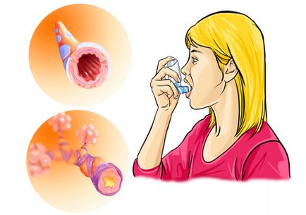 Bronșita - tratament și simptome ale bronșitei acute și cronice