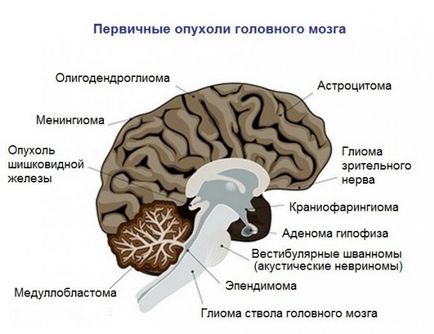 Care este diferența dintre kt a creierului și a creierului care este mai bine (diferența)