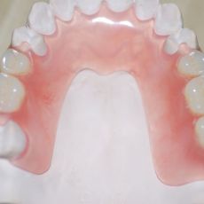 Чим приклеїти зуб до протезу