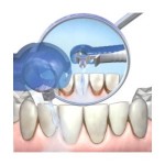 Curățarea dinților și a gingiilor cu ultrasunete