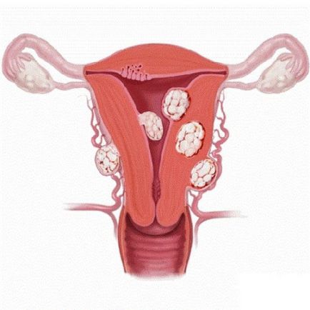 Ce este leiomiomul uterin submucosal