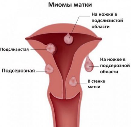 Ce este leiomiomul uterin submucosal