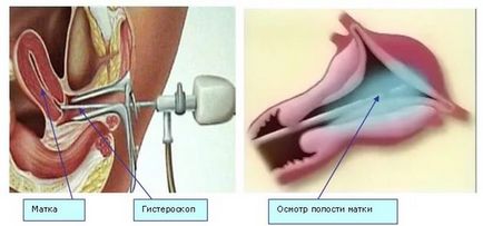 Що таке подслизистая лейомиома матки