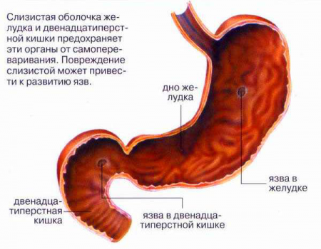 Cімптоми виразки шлунка і дванадцятипалої кишки
