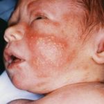 Cytomegalovirus (CMV) ce este această infecție la copii și adulți