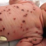 Cytomegalovirus (CMV) ce este această infecție la copii și adulți