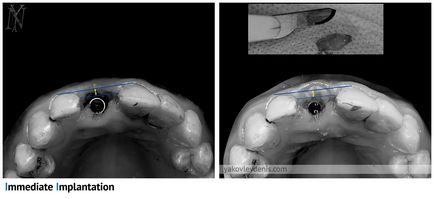 Fogászati implantáció, Denis Nikolaevich Jakovlev, fogorvos (implantáció) Fogászati implantáció, Denis Nikolaevich Yakovlev, fogorvos
