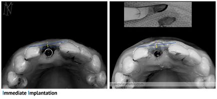 Implantul dentar, yakovlev denis Nikolaevich, dentist