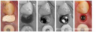 Fogászati implantáció, Denis Nikolaevich Jakovlev, fogorvos (orvos) Fogászati implantáció, Denis Nikolaevich Yakovlev, fogorvos