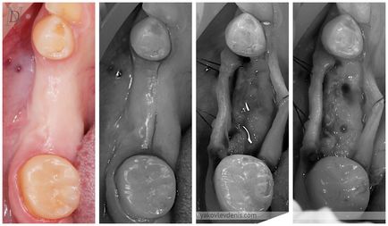 Implantul dentar, yakovlev denis Nikolaevich, dentist