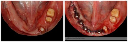 Implantul dentar, yakovlev denis Nikolaevich, dentist