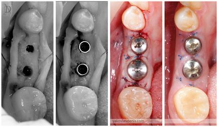 Fogászati implantáció, Jakovlev Denis N., fogorvos (extrakció után) Fogászati implantáció, Denis Nikolaevich Yakovlev, fogorvos