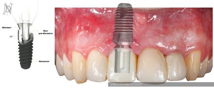 Fogászati implantáció, Denis Nikolaevich Jakovlev, fogorvos (orvos) Fogászati implantáció, Denis Nikolaevich Yakovlev, fogorvos