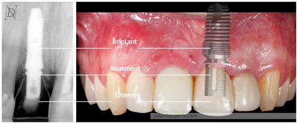 Implantul dentar, yakovlev denis Nikolaevich, dentist