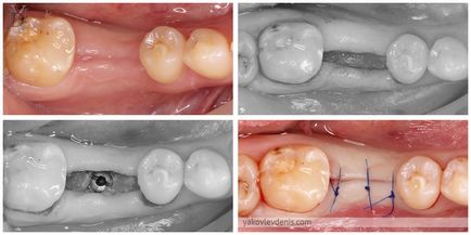 Implantul dentar, yakovlev denis Nikolaevich, dentist