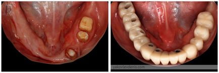 Implantul dentar, yakovlev denis Nikolaevich, dentist