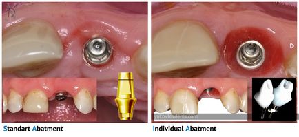 Implantul dentar, yakovlev denis Nikolaevich, dentist