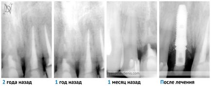 Implantul dentar, yakovlev denis Nikolaevich, dentist