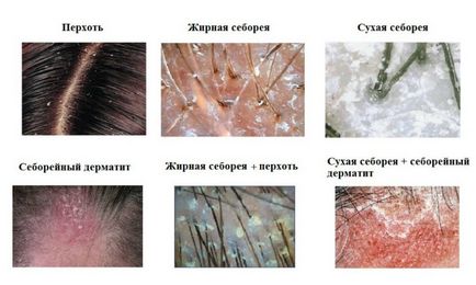Dermatita pe cap și scalp - tratament, simptome și fotografii