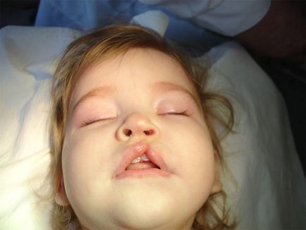 Chirurgie facială pediatrică