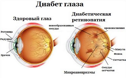 Diabetul ochiului - clinica Fedorov