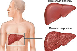 Діабет і печінку що потрібно для лікування хвороб