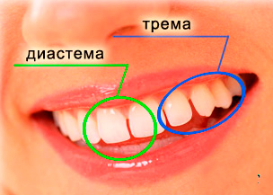 Диастема причини, симптоми, діагностика та її лікування