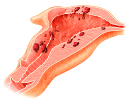 Endometrioza difuziva a corpului uterin - ecouri, cauze, tratament