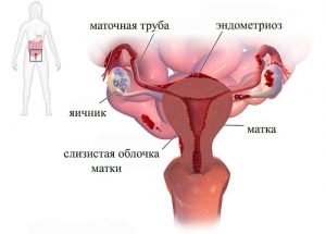 Дифузний ендометріоз тіла матки - ехопрізнакі, причини, лікування