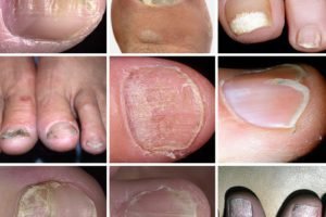 Дистрофія нігтів на руках і ногах лікування, профілактика, діагностика, фото - живи здорово