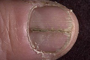 Distrofierea unghiilor pe tratamentul mâinilor și picioarelor, prevenirea, diagnosticarea, foto-vii sănătoși