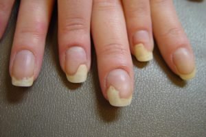 Distrofierea unghiilor pe tratamentul mâinilor și picioarelor, prevenirea, diagnosticarea, foto-vii sănătoși
