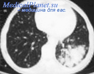 További sugárzás diagnózis tuberkulózis CT, MRI, ultrahang