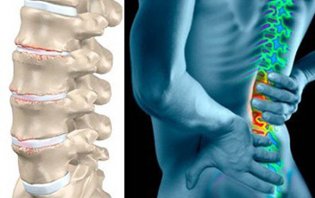 Dorsopatia simptomelor și tratamentului coloanei vertebrale lombare