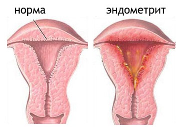 Tratamentul cu endometri și medicamente