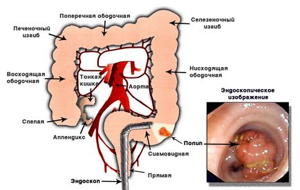 Examinarea endoscopică a intestinului gros, inclusiv a ileoscopiei terminale (colonoscopie)