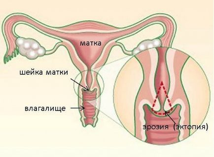 Eroziunea colului uterin și ipsosului.