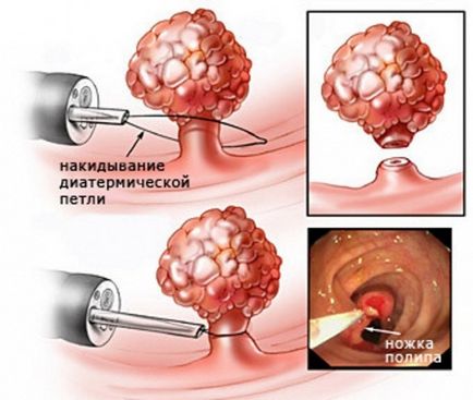 Eroziunea colului uterin și ipsosului.