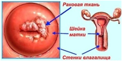 Eroziunea colului uterin și ipsosului.